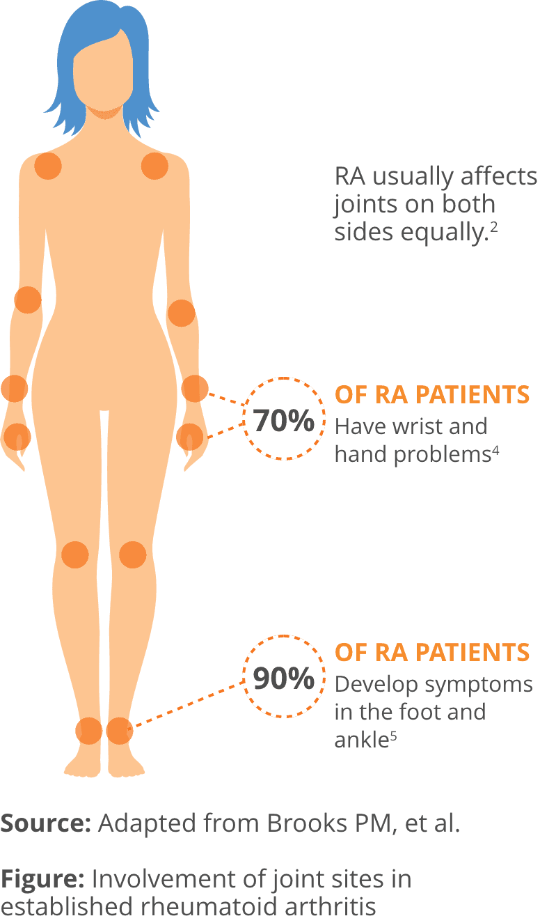 Female body diagram indicating joints that could be affected by RA